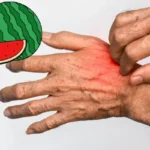 Hyödynnä vesimelonin kuoret ja lievitä ihoärsytyksiä