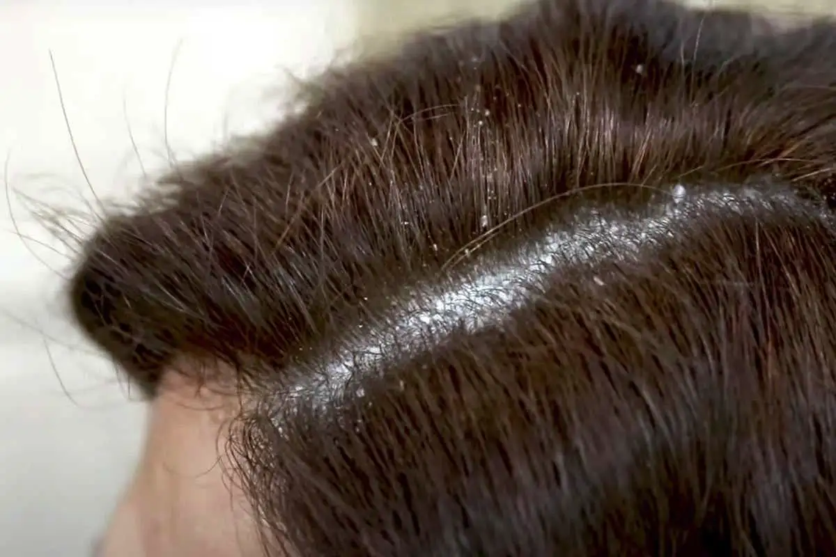 Suomalainen mummovinkki hilsettömään hiukseen: Luonnollinen hoito kotikeittiöstä