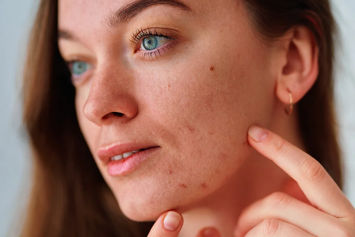 Luonnolliset aknen hoitokeinot Suomessa: trendikkäät tavat saada puhdas iho