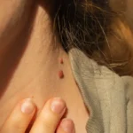 Tämä kuori voi poistaa syyliä: Näin käytät sitä oikein!