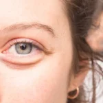 Kylmä lusikka -rentoutus: Suomalainen kikka silmien raikastamiseen