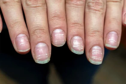 Kynsien uurteet: Mitä ne tarkoittavat ja miten ne voivat vaikuttaa terveyteesi?