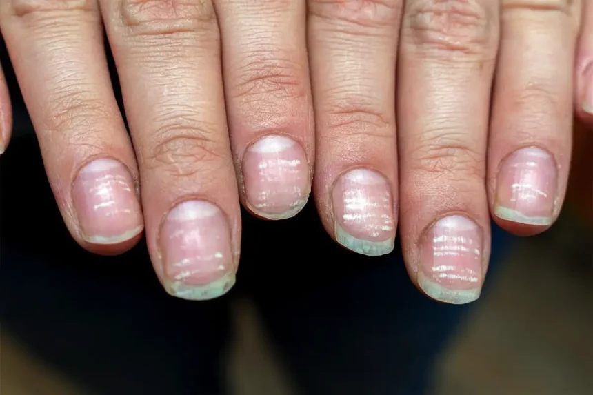 Kynsien uurteet: Mitä ne tarkoittavat ja miten ne voivat vaikuttaa terveyteesi?