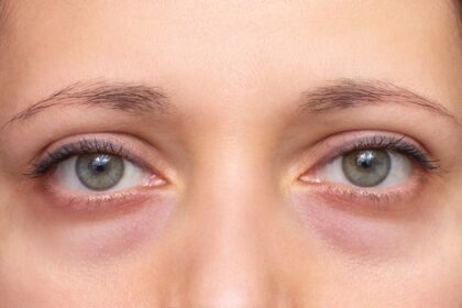 Näin muokkaat ruokavaliota turvotuksen vähentämiseksi – ravitsemusterapeutin vinkit